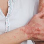 radiotusciaevents.com Psoriasi, pressing Apiafco per piano nazionale cronicità
