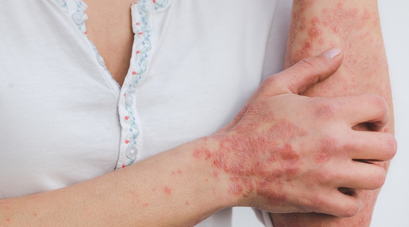 radiotusciaevents.com Psoriasi, pressing Apiafco per piano nazionale cronicità